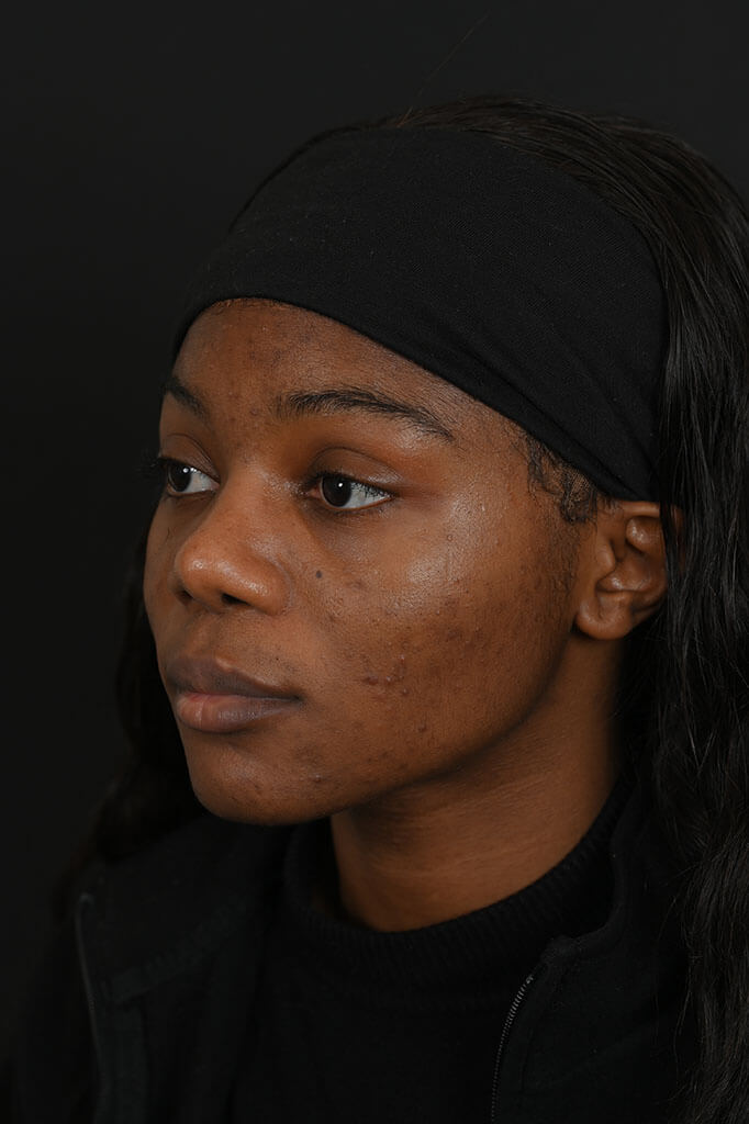 Black female rhinoplasty patient, after nose surgery by Houston nose surgeon Dr. Michel Siegel