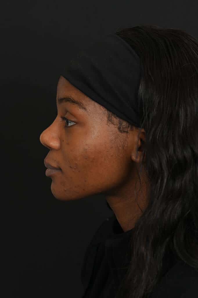 Black female rhinoplasty patient, after nose surgery by Houston nose surgeon Dr. Michel Siegel