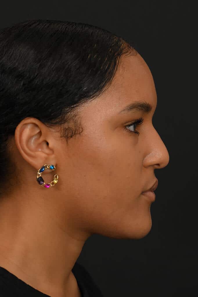 Black female rhinoplasty patient, before nose surgery by Houston nose surgeon Dr. Michel Siegel