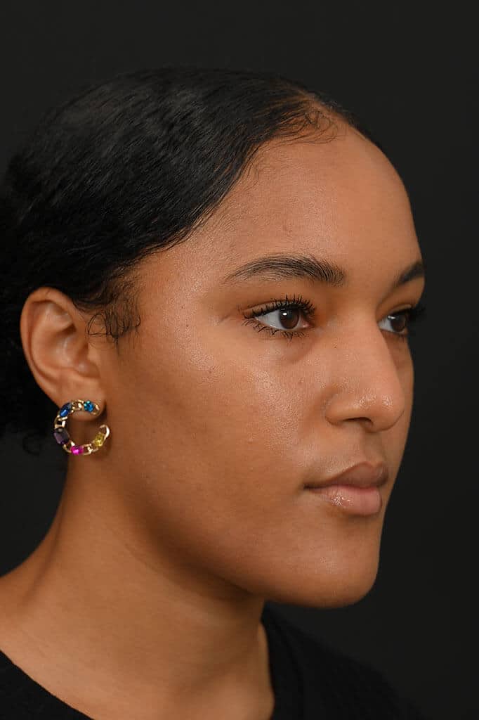 Black female rhinoplasty patient, before nose surgery by Houston nose surgeon Dr. Michel Siegel