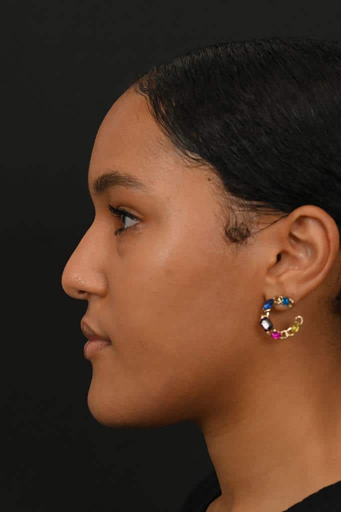 Black female rhinoplasty patient, before nose surgery by Houston nose surgeon Dr. Michel Siegel