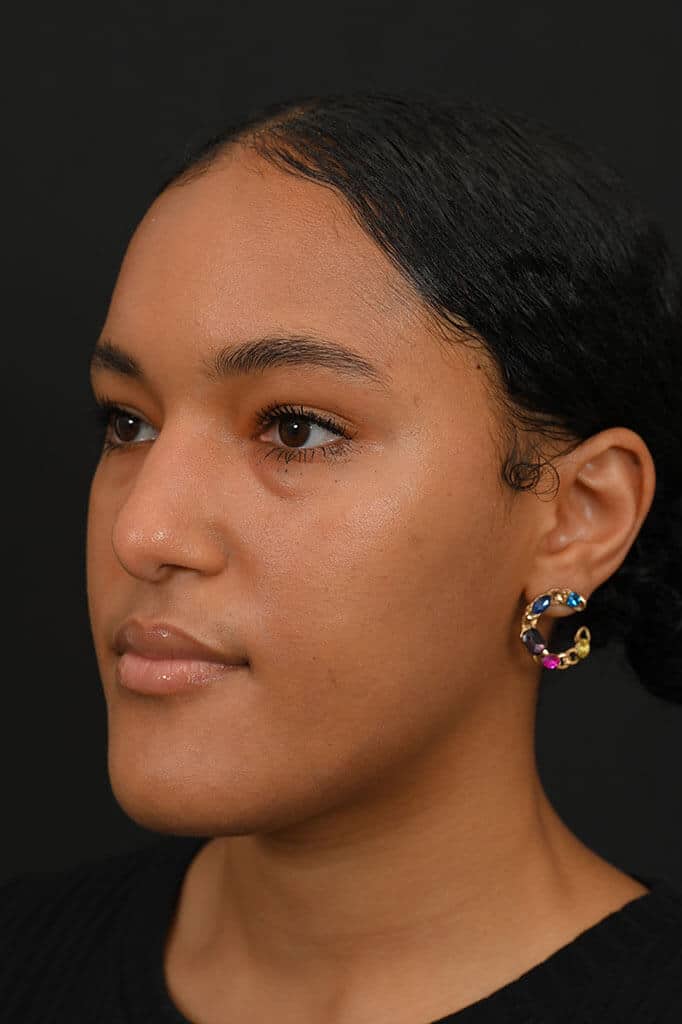 Black female rhinoplasty patient, before nose surgery by Houston nose surgeon Dr. Michel Siegel