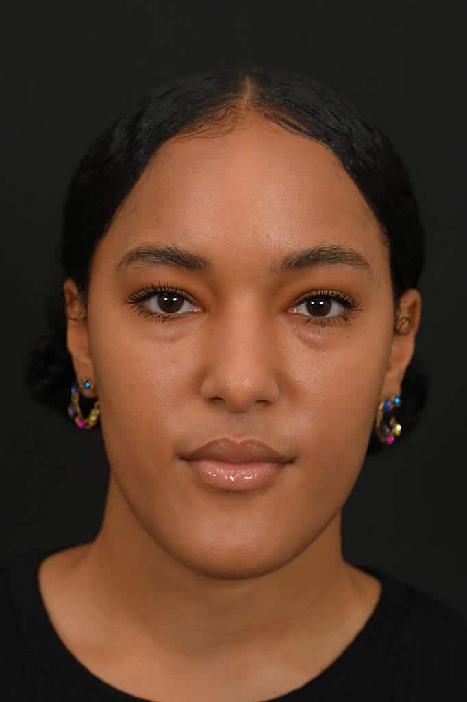 Black female rhinoplasty patient, before nose surgery by Houston nose surgeon Dr. Michel Siegel