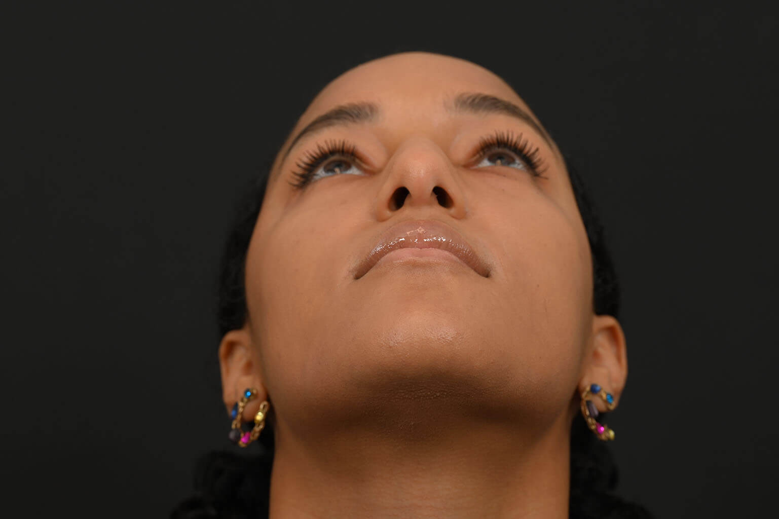 Black female rhinoplasty patient, before nose surgery by Houston nose surgeon Dr. Michel Siegel