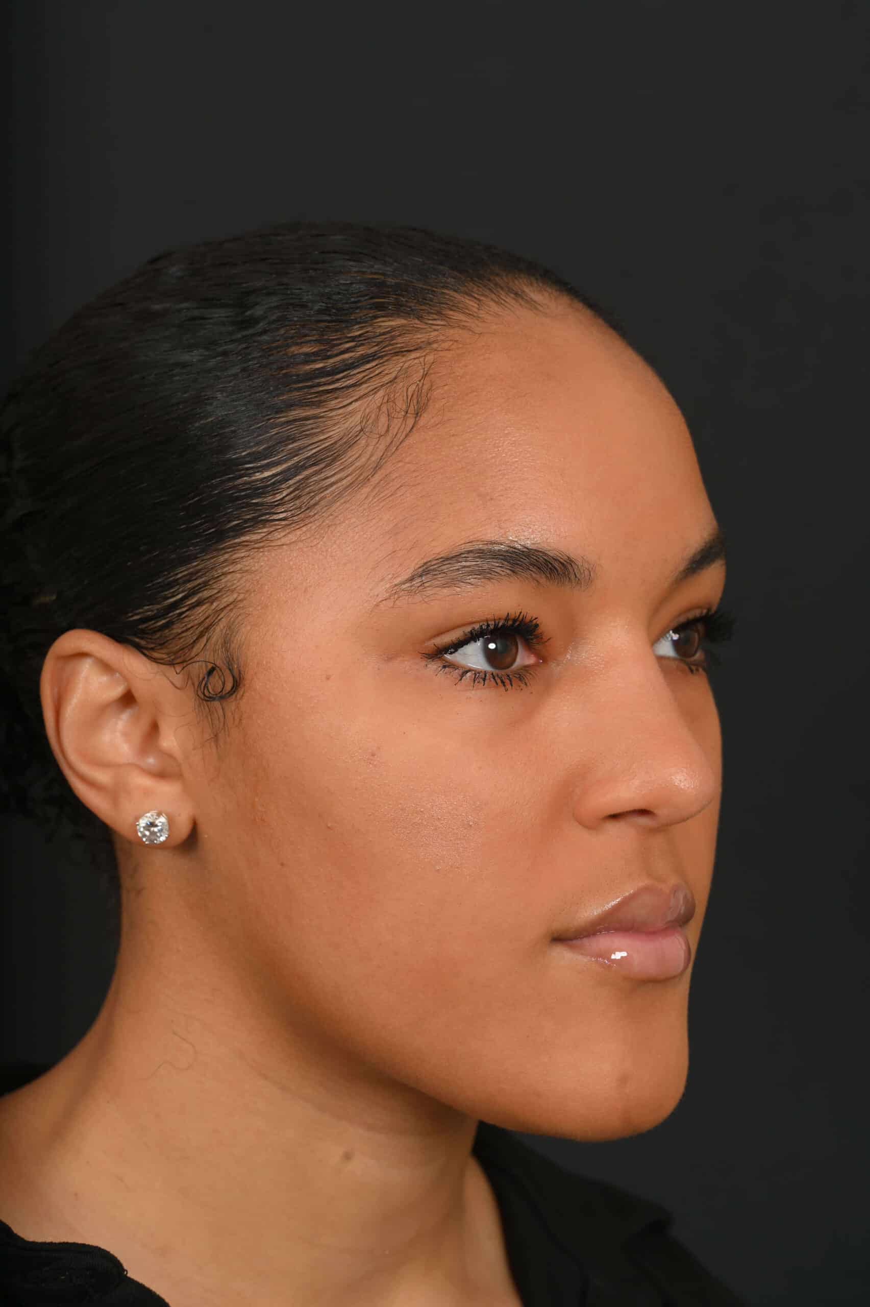 Black female rhinoplasty patient, after nose surgery by Houston nose surgeon Dr. Michel Siegel