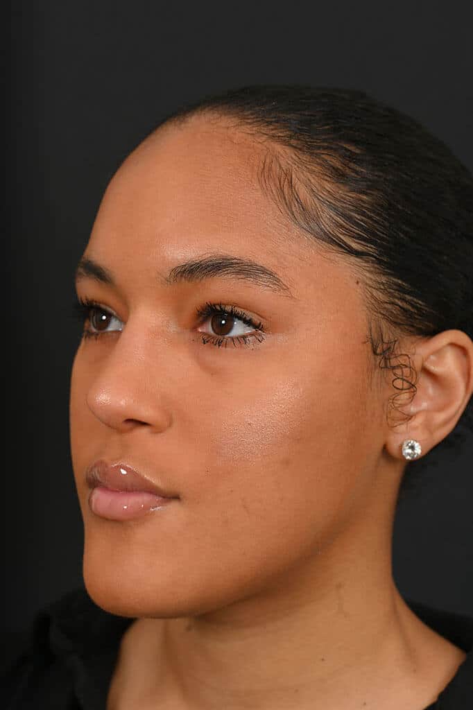 Black female rhinoplasty patient, after nose surgery by Houston nose surgeon Dr. Michel Siegel
