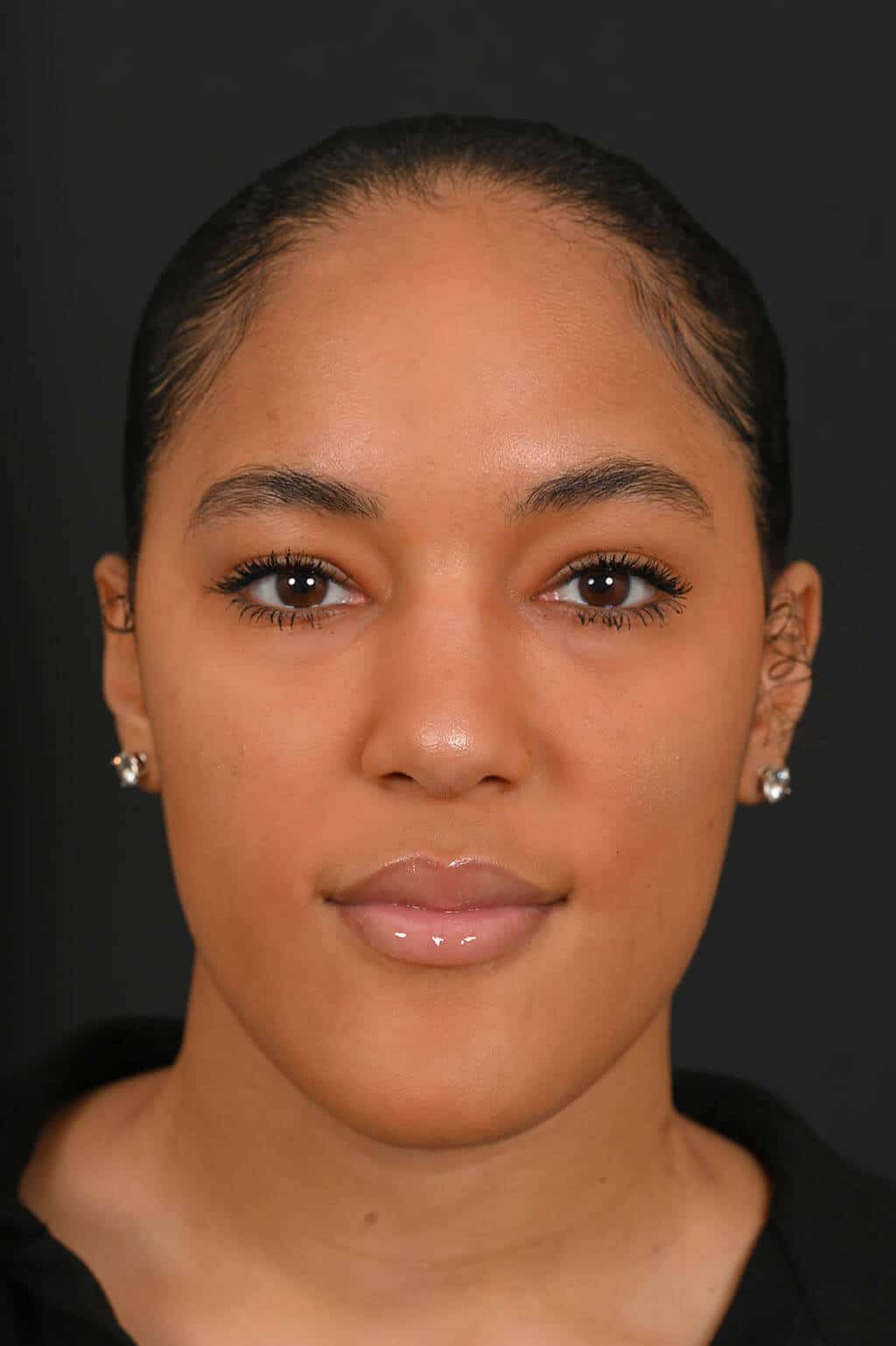 Black female rhinoplasty patient, after nose surgery by Houston nose surgeon Dr. Michel Siegel