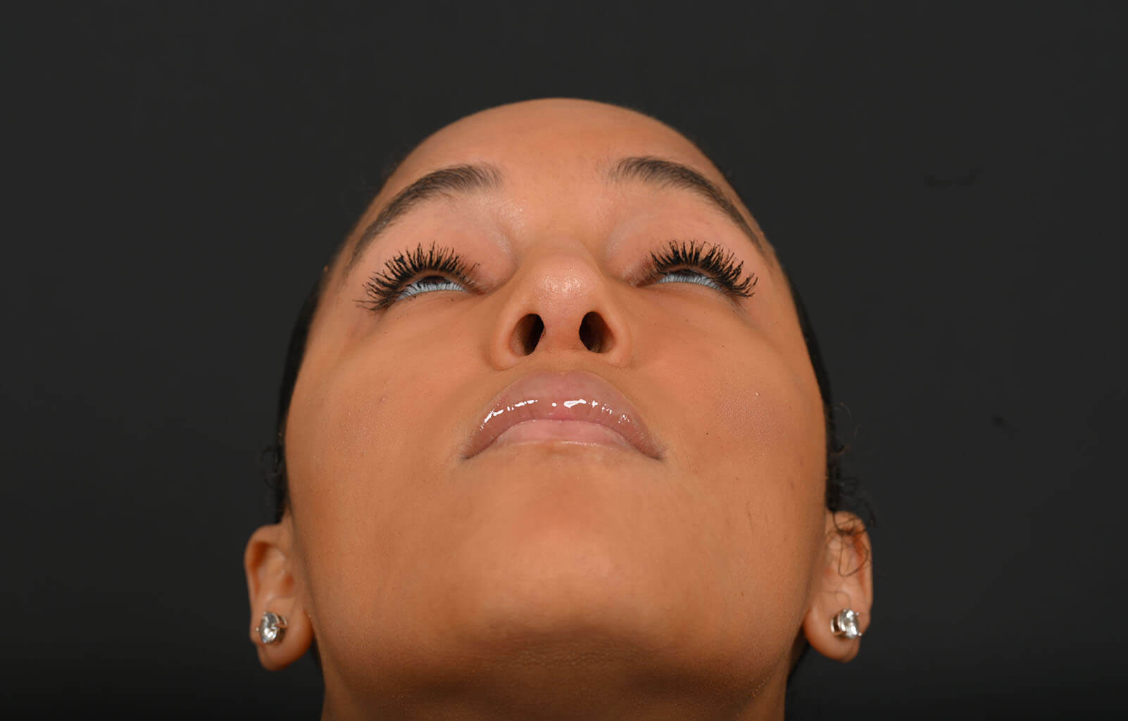 Black female rhinoplasty patient, after nose surgery by Houston nose surgeon Dr. Michel Siegel