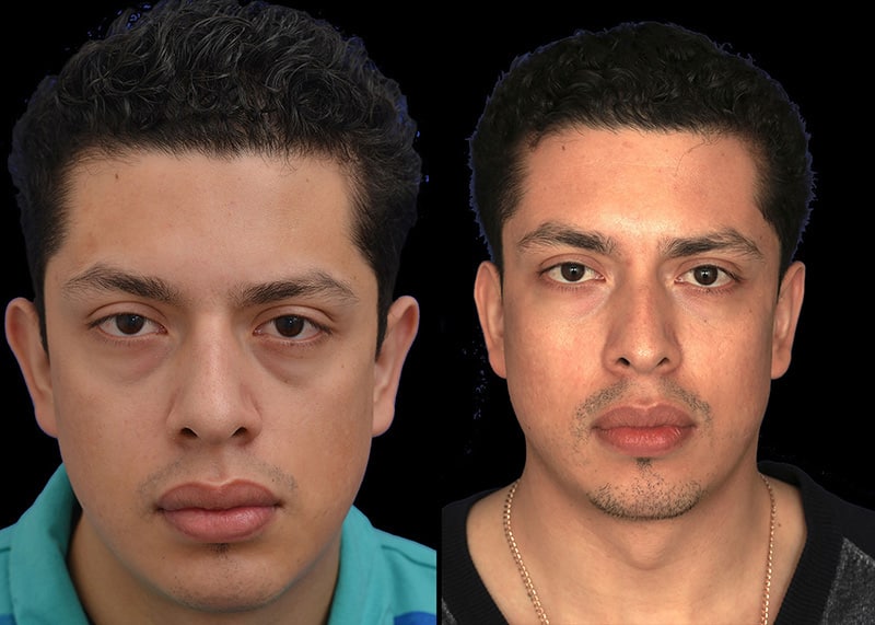 Otoplasty (ear surgery) patient, before and after ear surgery by Houston facial surgeon Dr. Michel Siegel