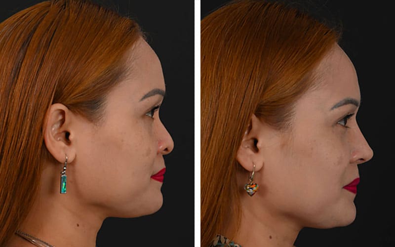 Asian Rhinoplasty