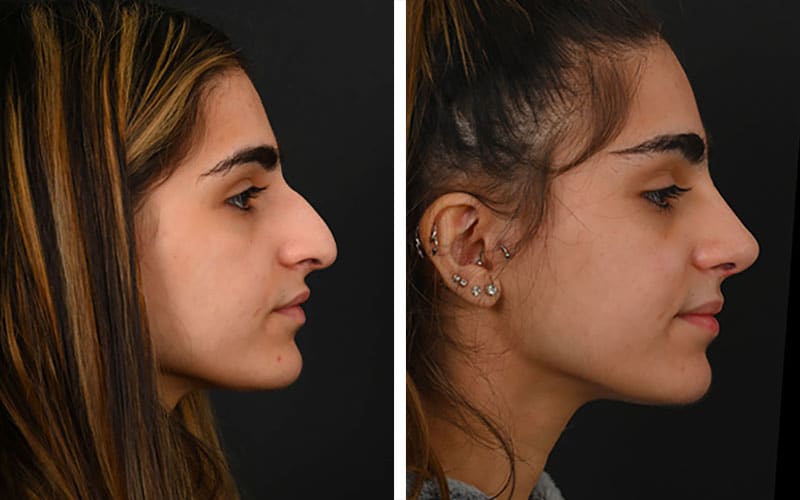 Indian and Middle Eastern Rhinoplasty
