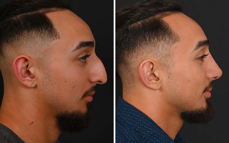 Male Rhinoplasty - Example 1