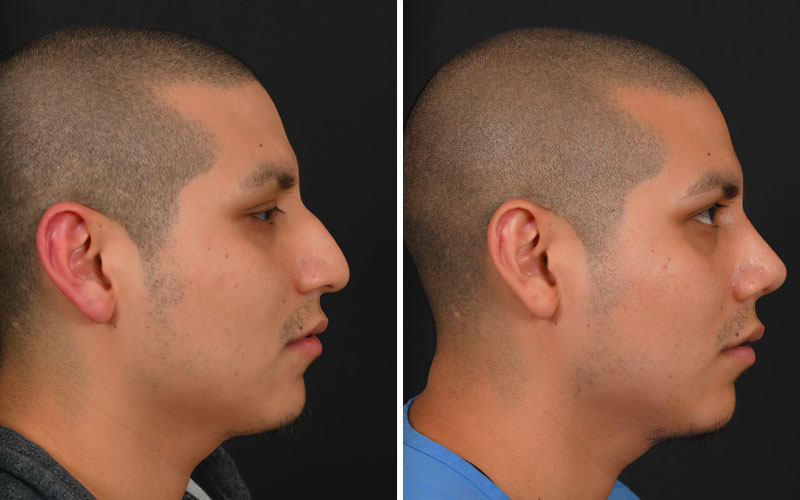 Female Rhinoplasty 2