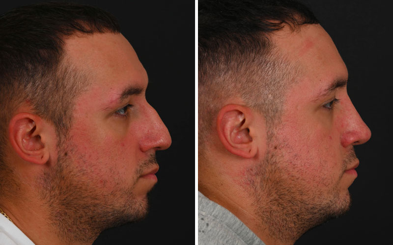 Male Rhinoplasty - Example 3