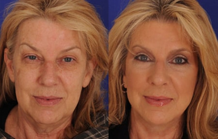 Neck lift results in Houston