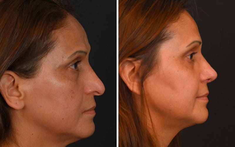 Revision Rhinoplasty Before and After Example
