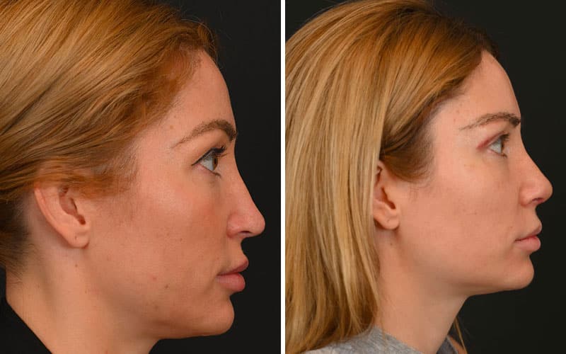 Revision Rhinoplasty Before and After Example