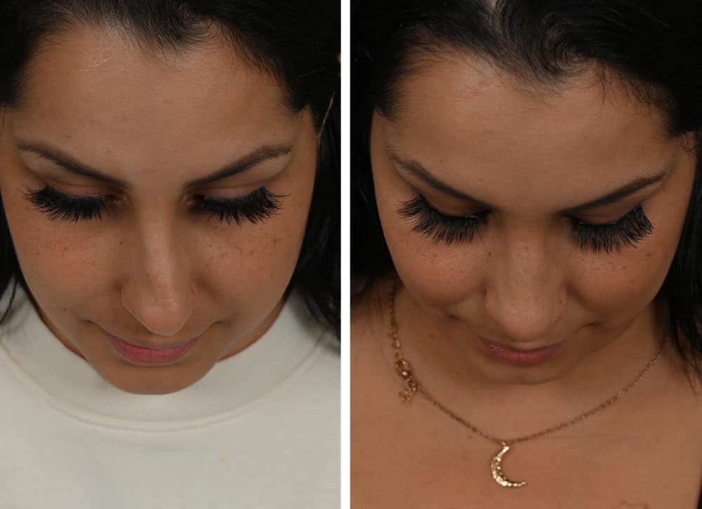 Before and after rhinoplasty for a crooked nose