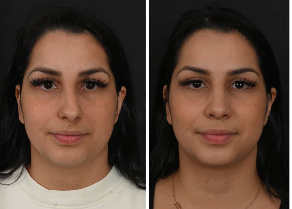 Before and after rhinoplasty for a crooked nose - alternate view