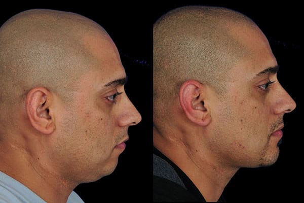 Chin Surgery Photos