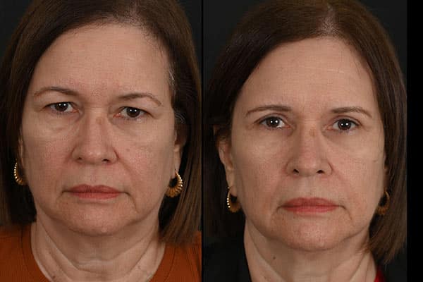 Eyelid Surgery Photos