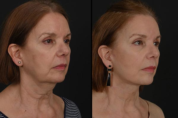 Facelift Photos