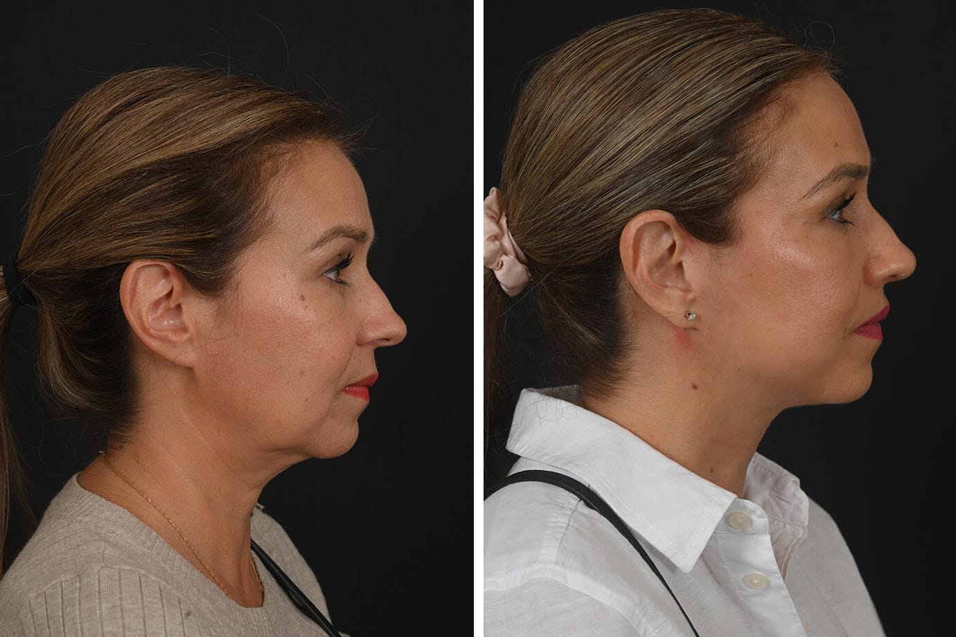 Mini deep plane facelift, before and after, performed by Houston's Dr. Michel Siegel