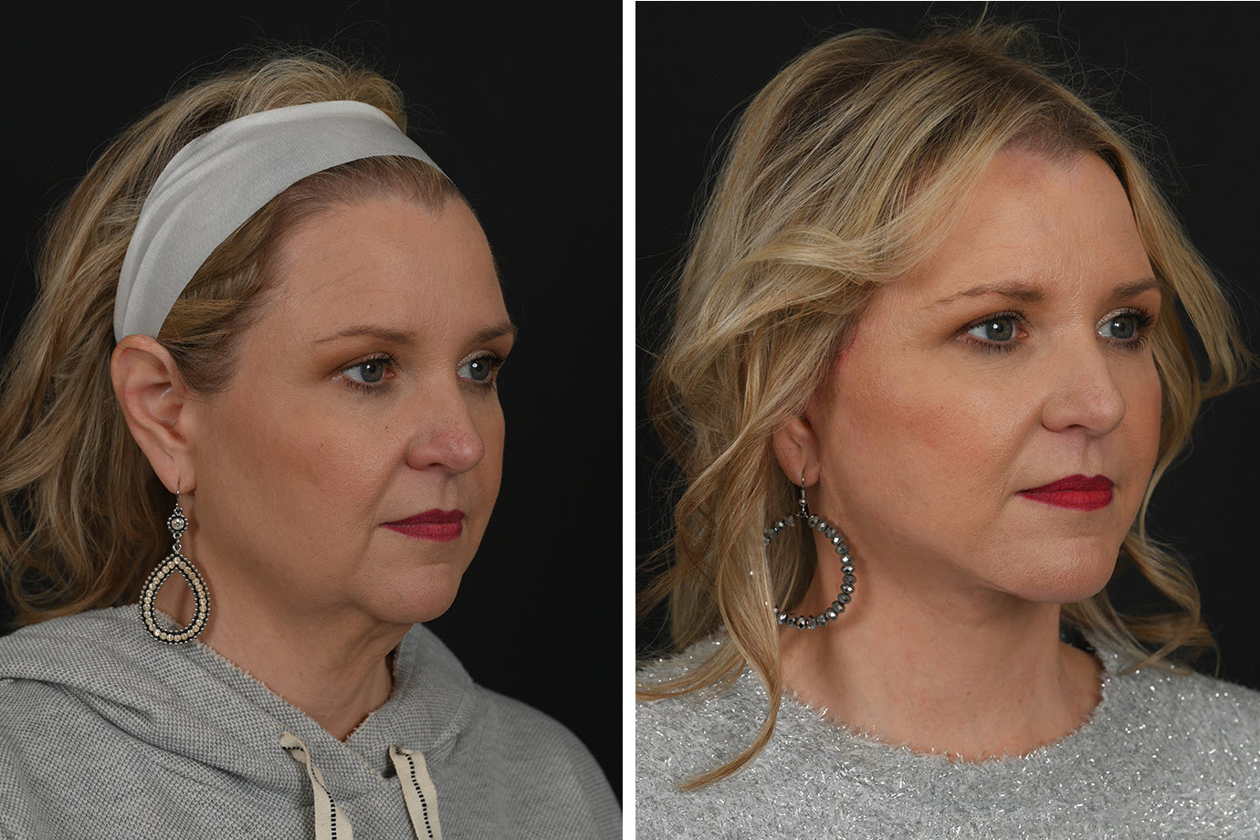 Mini deep plane facelift, before and after, performed by Houston's Dr. Michel Siegel
