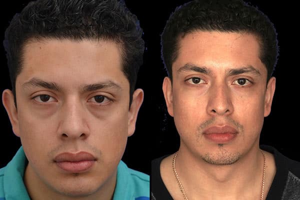 Other Plastic Surgery Photos