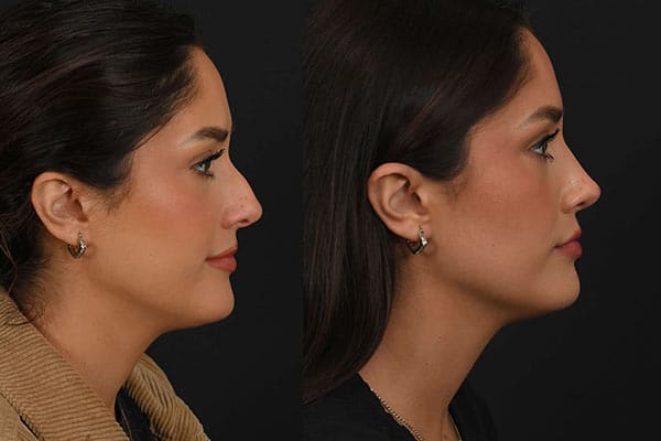 Rhinoplasty Photos