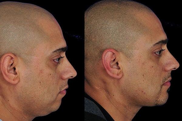 Chin Surgery