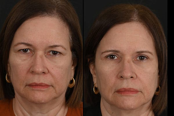 Eyelid Surgery