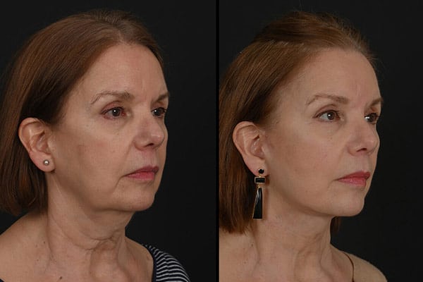 Facial Procedures