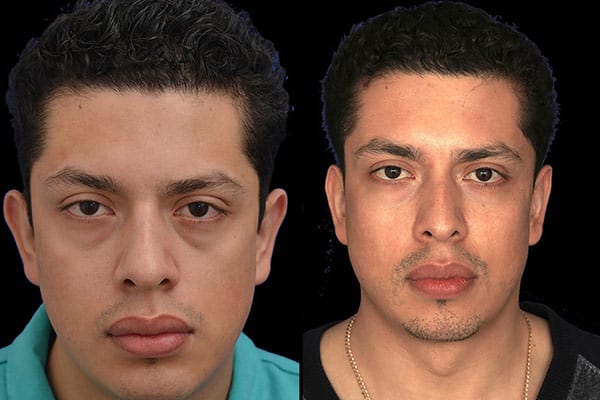Otoplasty Surgery