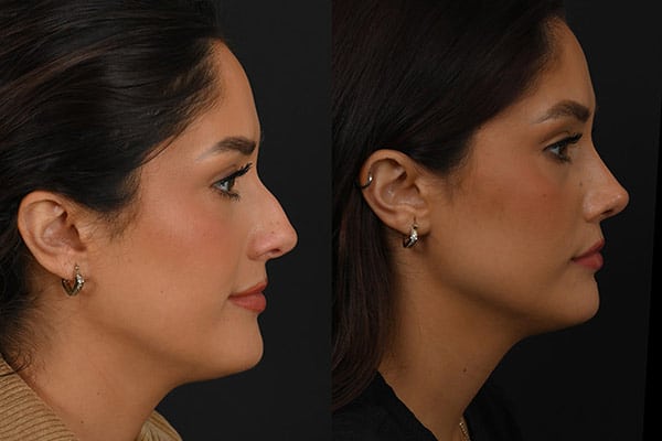 Rhinoplasty Procedures