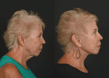 Neck lift results in Houston