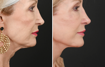 Facelift photos