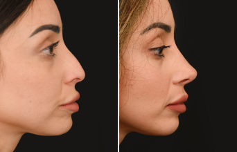 Rhinoplasty photos