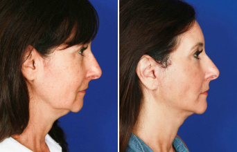 Facelift