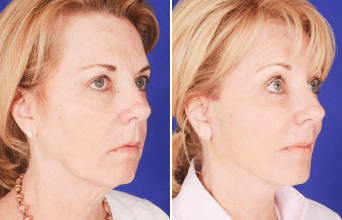 Chin implant before and after