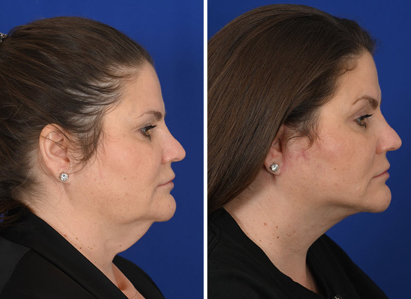 Deep plane facelift before and after