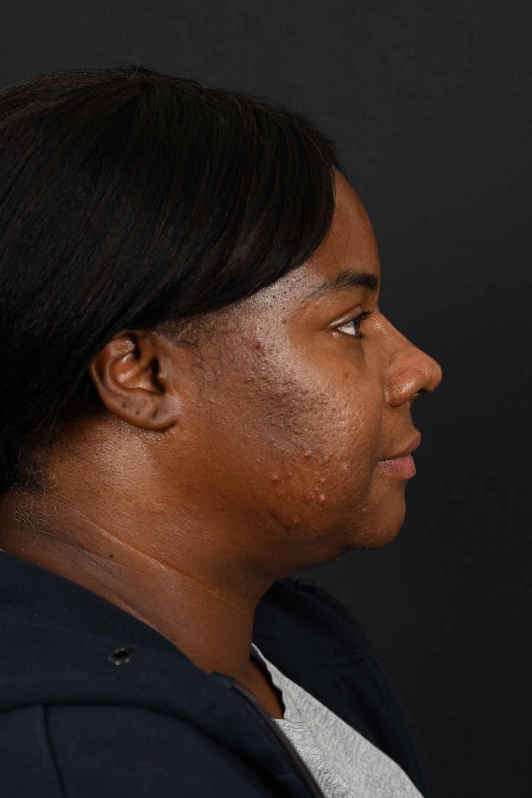 Female black rhinoplasty patient, before and after nose surgery by Houston nose surgeon Dr. Michel Siegel