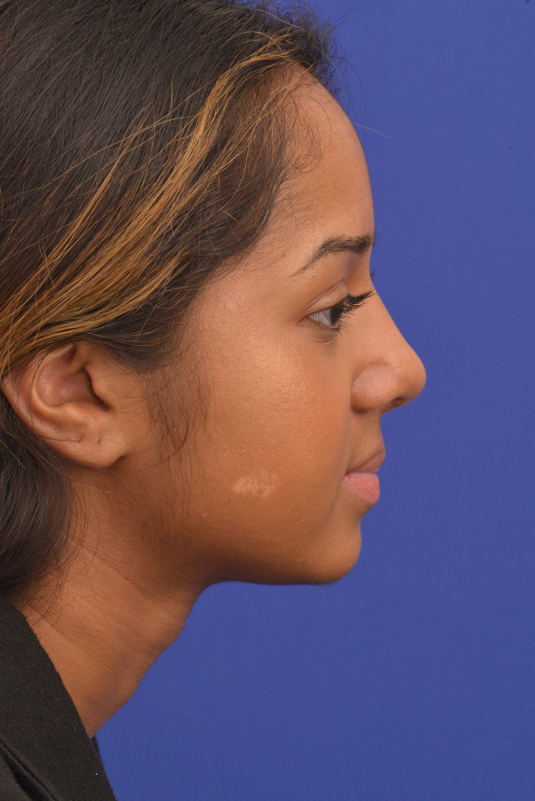 Female Indian rhinoplasty patient, before and after nose surgery by Houston nose surgeon Dr. Michel Siegel