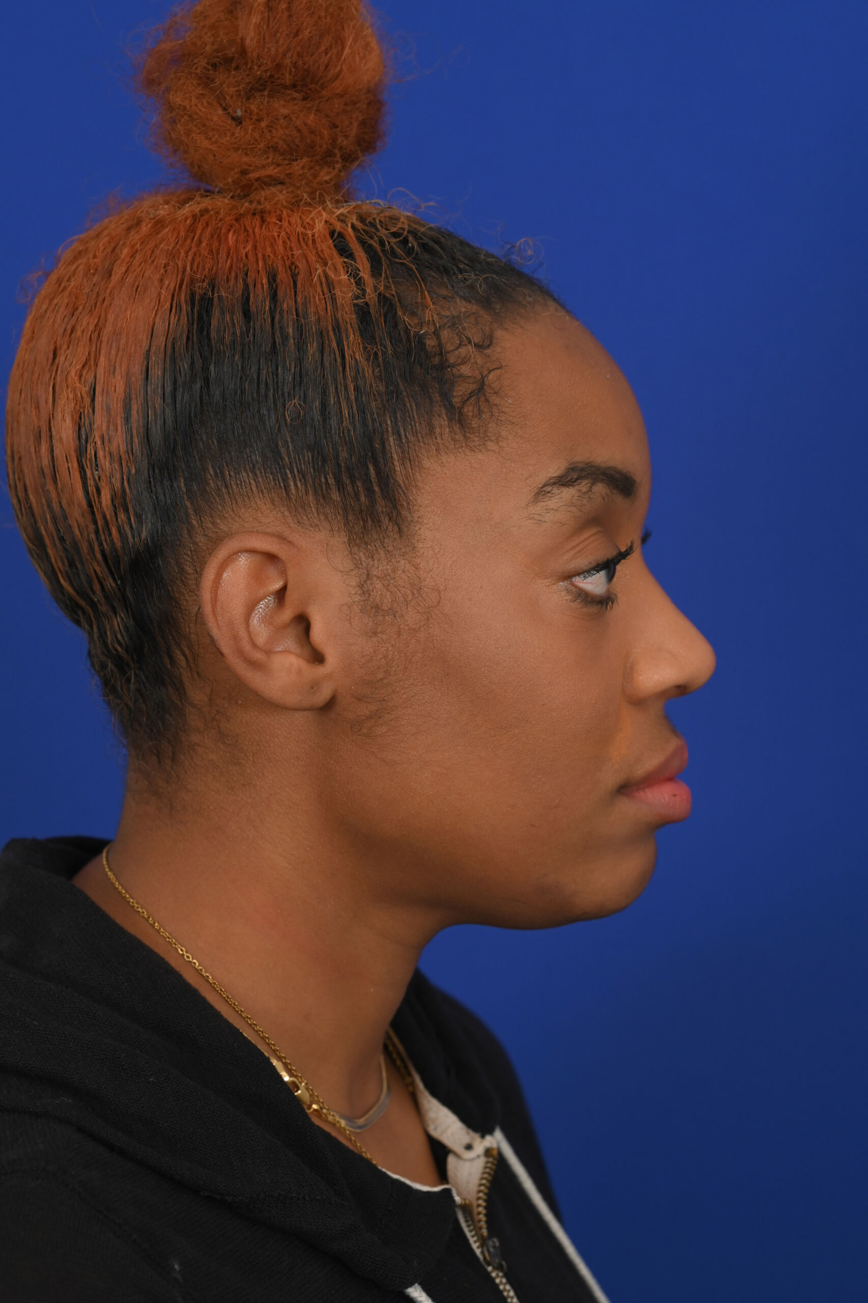 Female black rhinoplasty patient, before and after nose surgery by Houston nose surgeon Dr. Michel Siegel