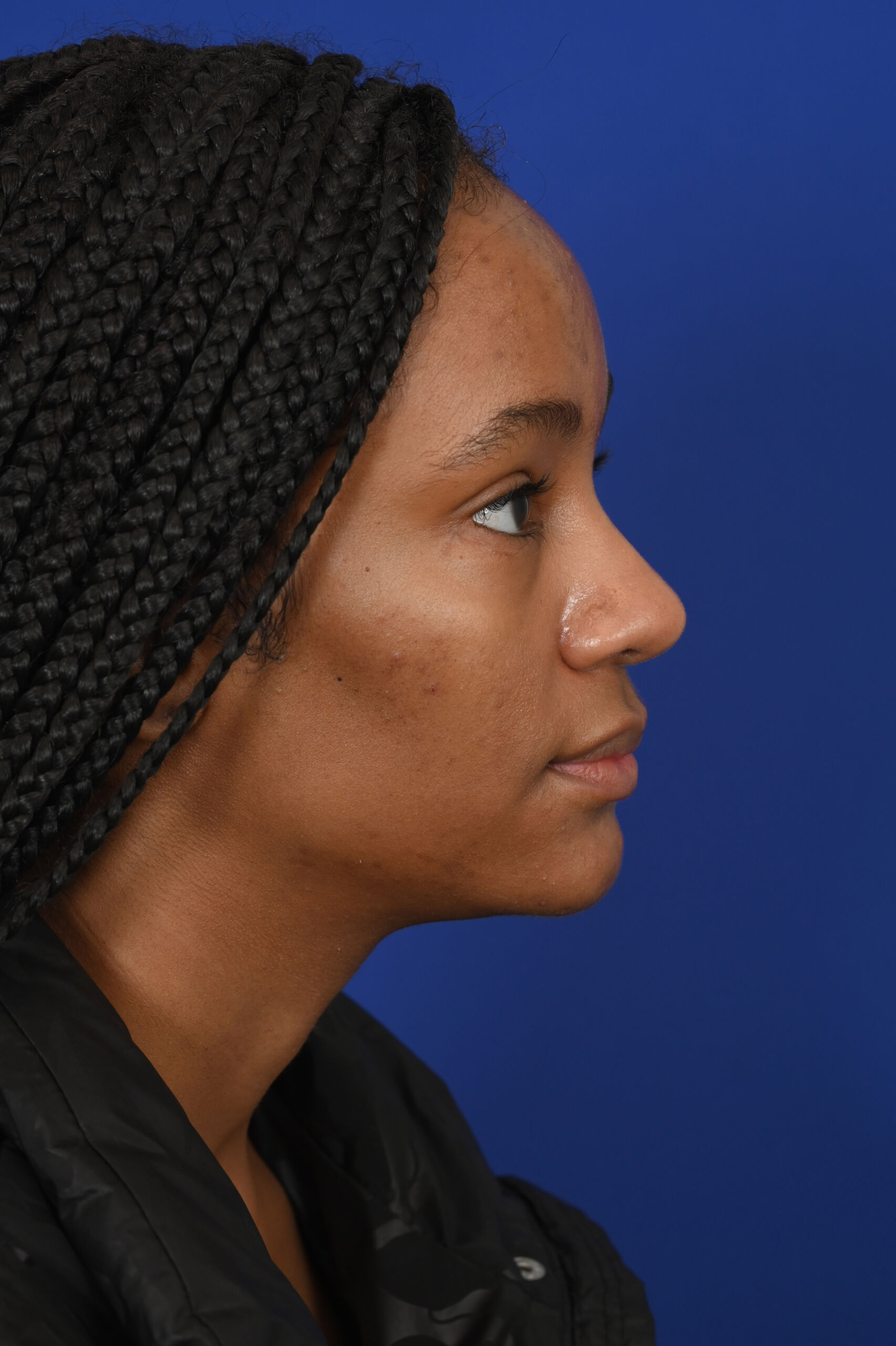 Female black rhinoplasty patient, before and after nose surgery by Houston nose surgeon Dr. Michel Siegel