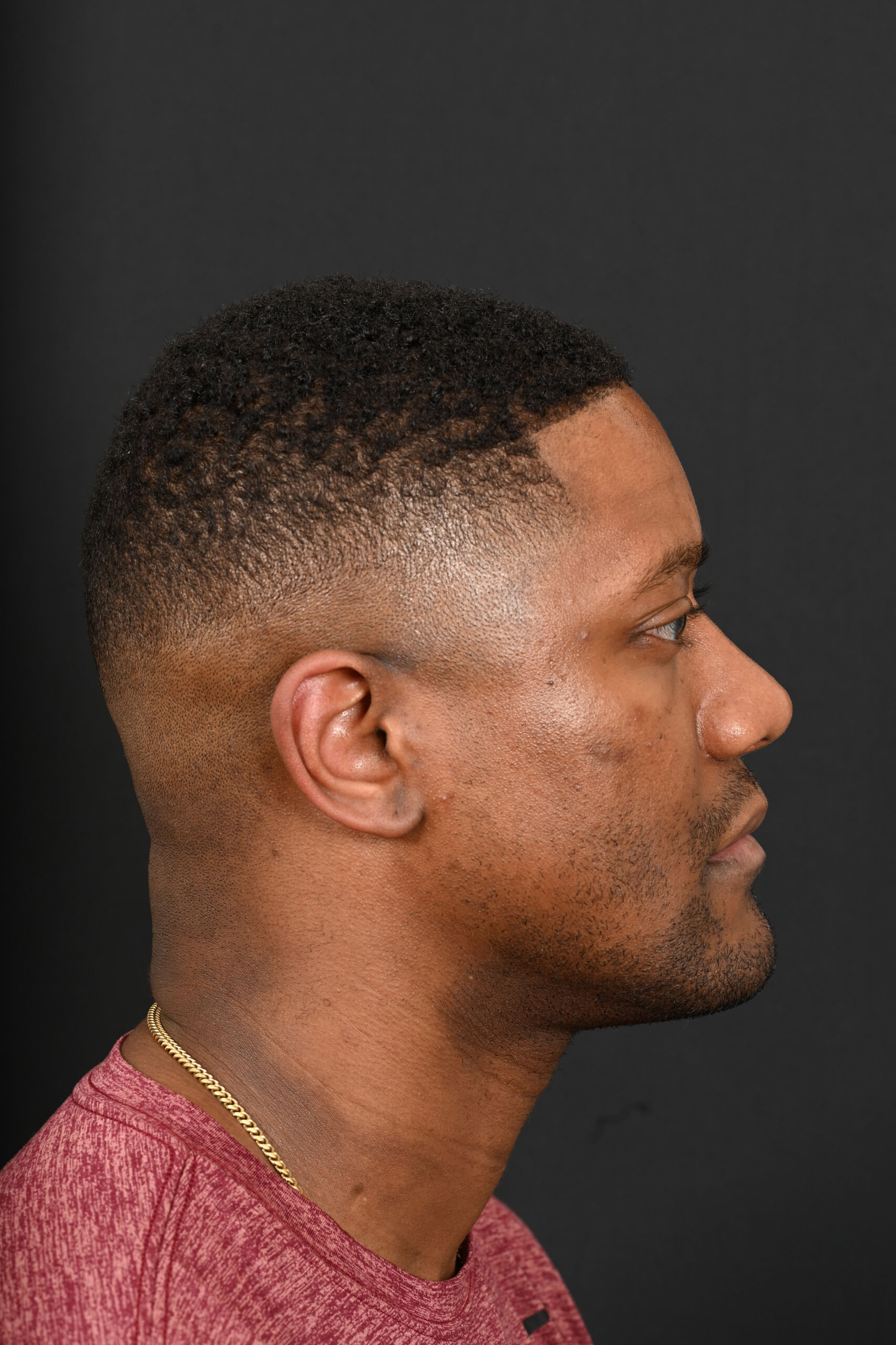 Male black rhinoplasty patient, before and after nose surgery by Houston nose surgeon Dr. Michel Siegel