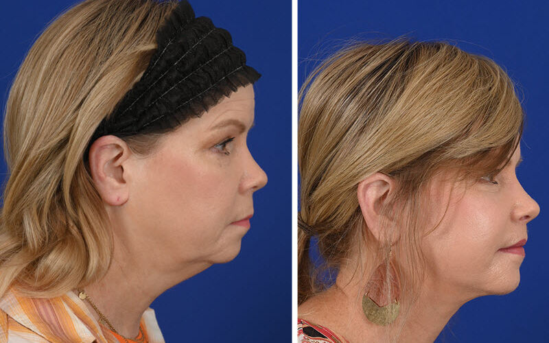 Deep plane facelift before and after