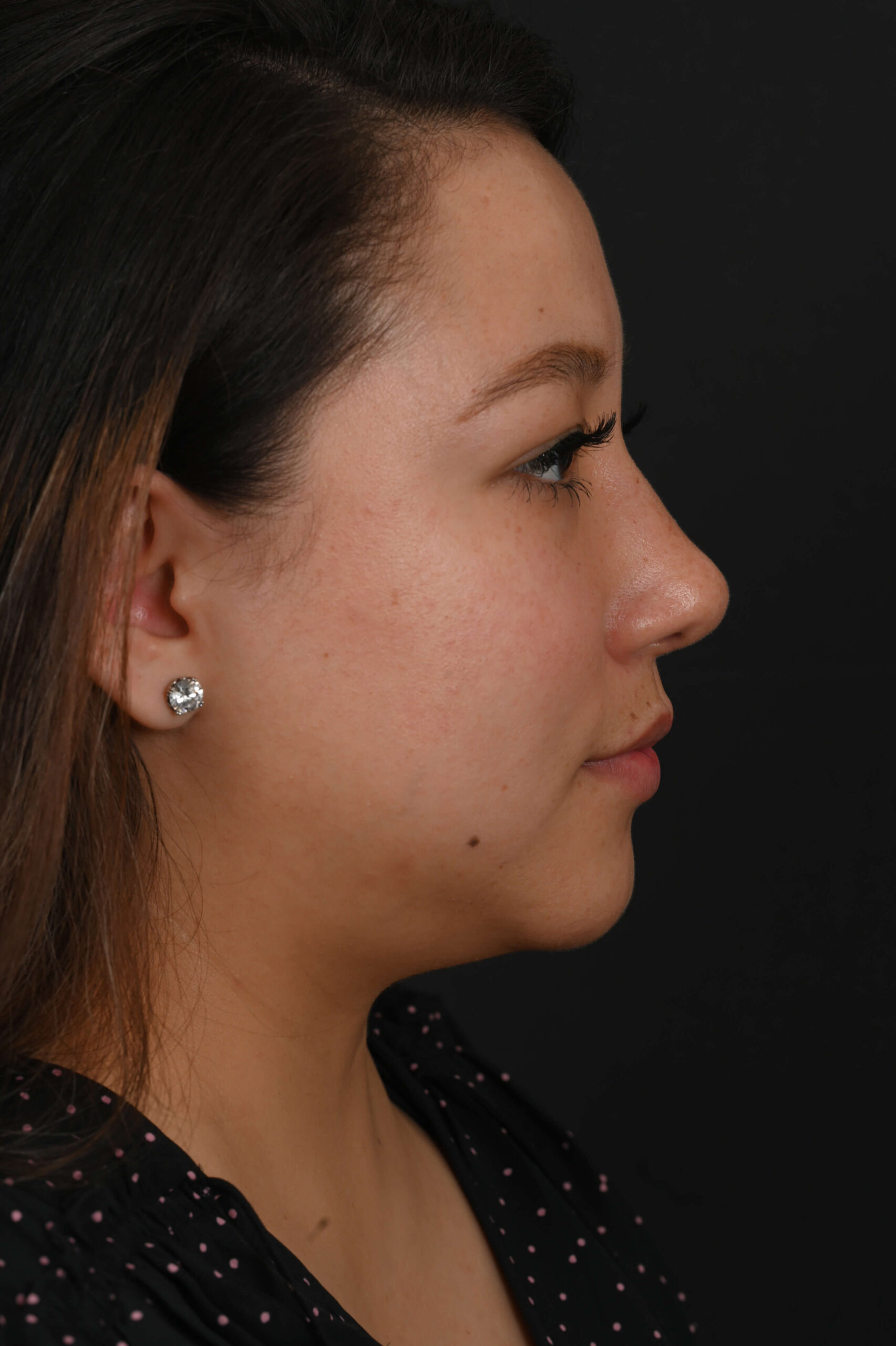 Latina rhinoplasty patient, before and after nose surgery by Houston nose surgeon Dr. Michel Siegel