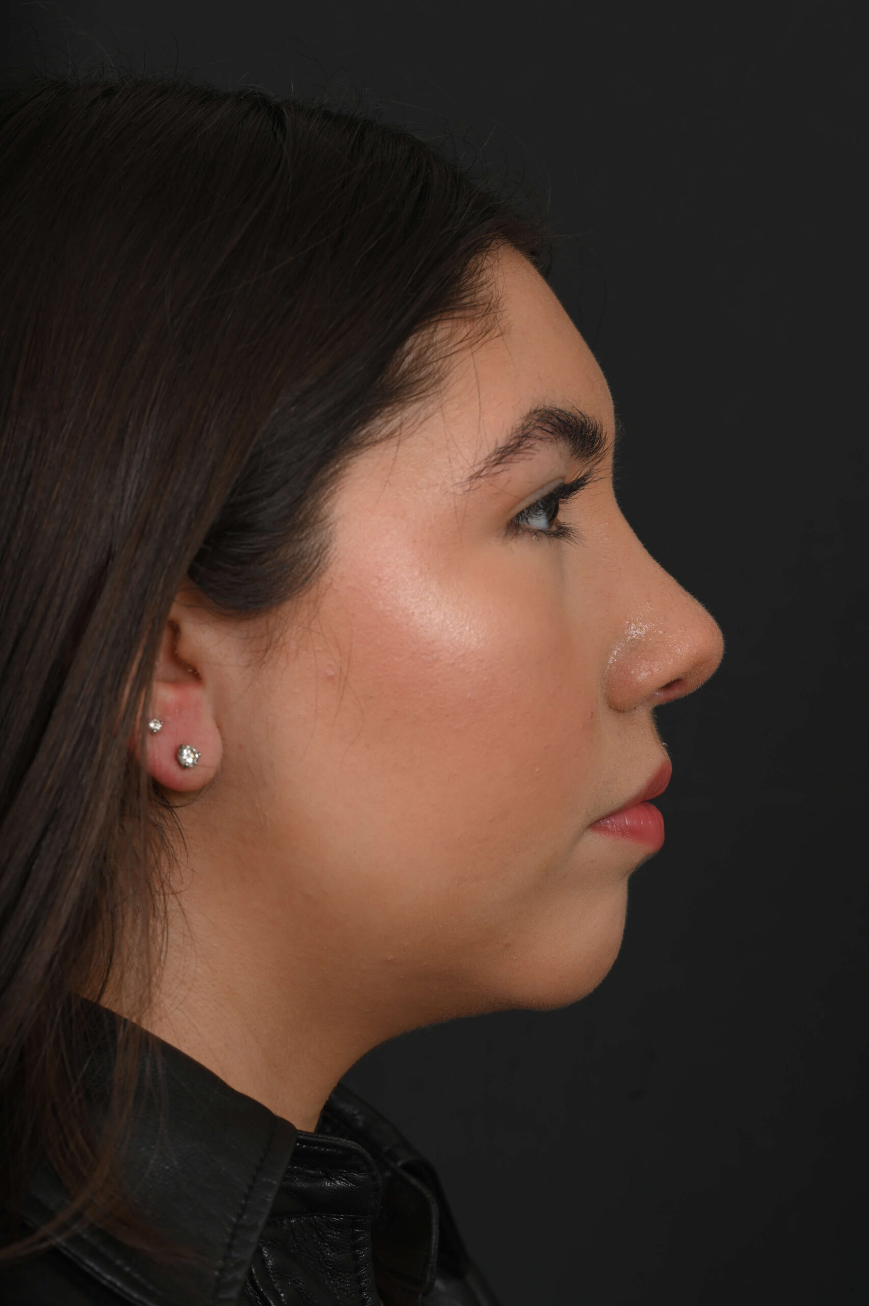Latina rhinoplasty patient, before and after nose surgery by Houston nose surgeon Dr. Michel Siegel