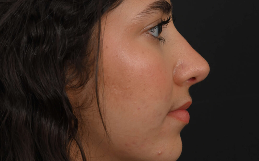Female Middle Eastern rhinoplasty patient, before and after nose surgery by Houston nose surgeon Dr. Michel Siegel